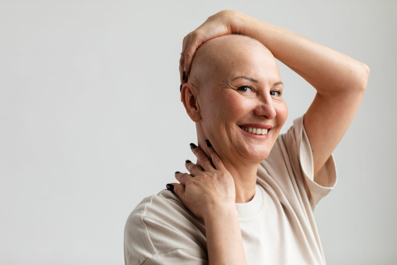 Identifica los tipos de alopecia en mujeres